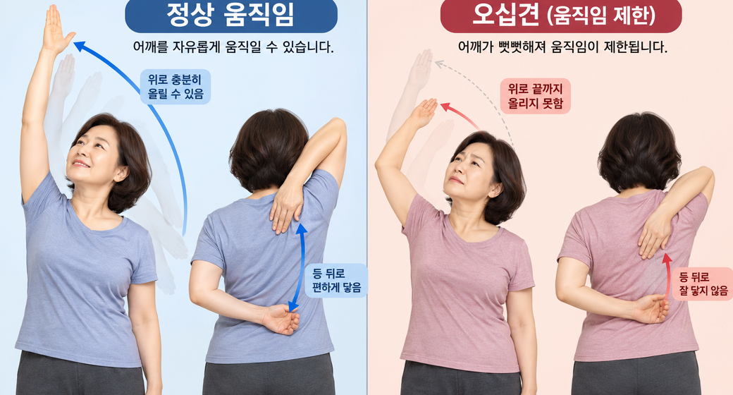 50대 어깨가 뻣뻣해지는 이유｜오십견일까? 평소 관리하는 방법