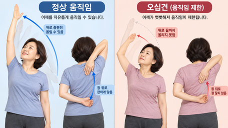 50대 어깨가 뻣뻣해지는 이유｜오십견일까? 평소 관리하는 방법